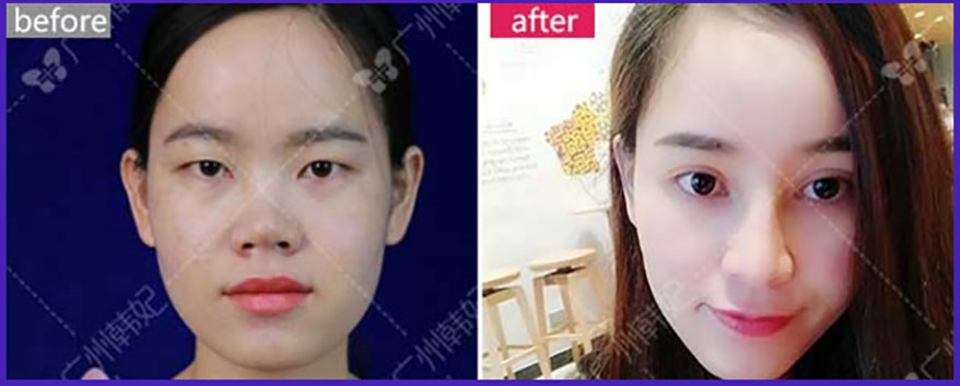 closed rhinoplasty recovery